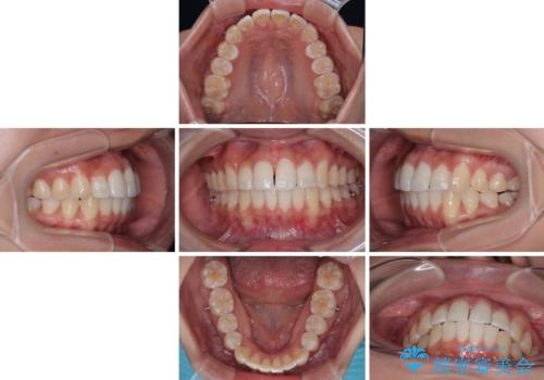前歯のデコボコを治したい インビザライン矯正の治療中