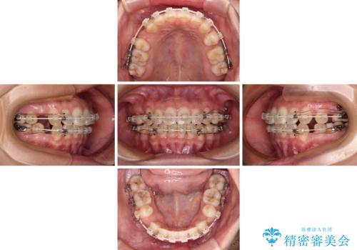 横顔の印象を変えたい ワイヤー装置での抜歯矯正の治療中