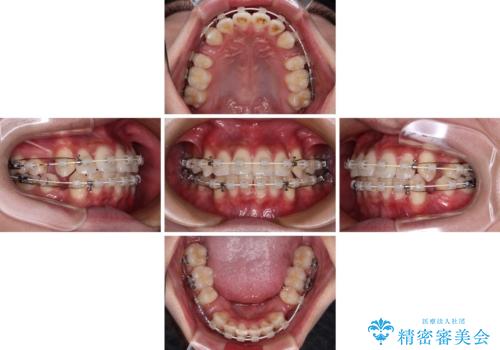 【モニター】デコボコ前歯をワイヤー装置での抜歯矯正で改善の治療中