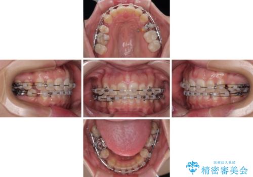 出っ歯と奥歯のむし歯 ワイヤー装置での抜歯矯正とセラミック治療の治療中