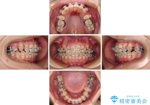 八重歯を改善 ワイヤー装置での抜歯矯正の治療中