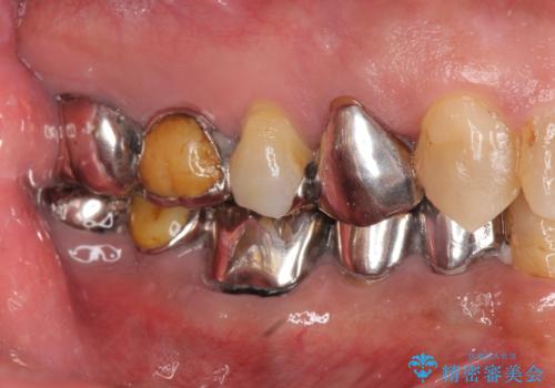 多数の銀歯と虫歯、セラミック・インプラント治療の症例 治療前