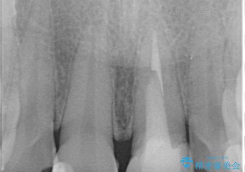 前歯の見た目を良くしたい　オールセラミッククラウンの治療前
