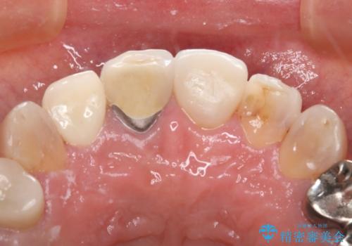 前歯を綺麗にしたい オールセラミッククラウンの治療後
