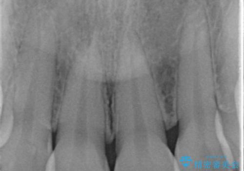 前歯を綺麗にしたい。の治療前