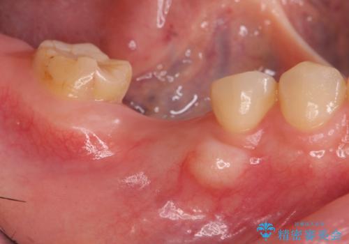 審美性に優れるノンクラスプデンチャーの治療前