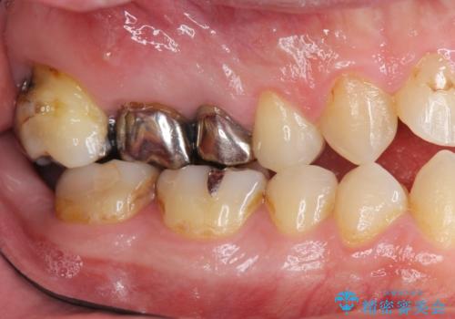 奥歯ブリッジの症例 治療前