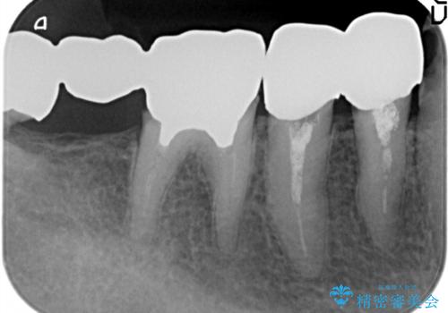 多数の銀歯と虫歯、セラミック・インプラント治療の治療前