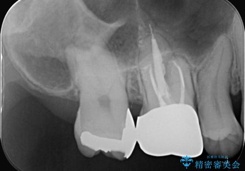 【セラミッククラウン】歯に穴が空いているの治療前