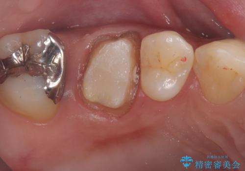 【セラミッククラウン】歯に穴が空いているの治療中