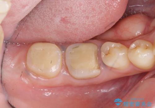 歯冠長延長術・骨隆起除去を行った、スペースの少ないセラミック治療の治療中