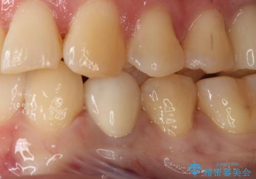 セラミックの被せ物を入れたい フルジルコニアクラウンの治療後