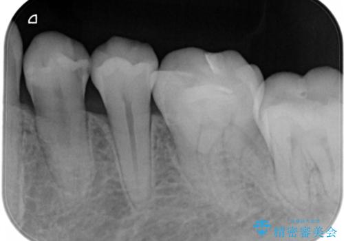 セラミックの被せ物を入れたい フルジルコニアクラウンの治療前