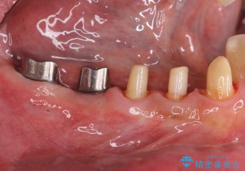 多数の銀歯と虫歯、セラミック・インプラント治療の治療中