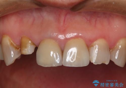 前歯を綺麗にしたい オールセラミッククラウンの治療中