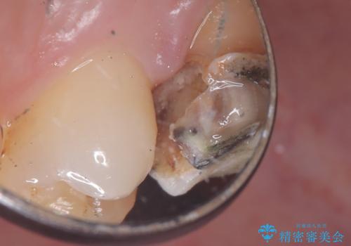 【セラミッククラウン】歯に穴が空いているの治療中