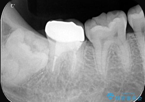 銀歯を白くしたい|オールセラミッククラウンの治療後