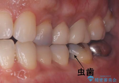 セラッミクインレー|オールセラミッククラウン|銀歯による二次カリエス|ラバーダムシート使用の治療中