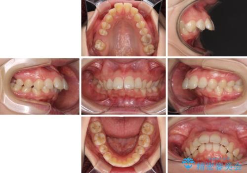 飛び出した前歯 抜歯矯正で横顔が劇的変化の治療前