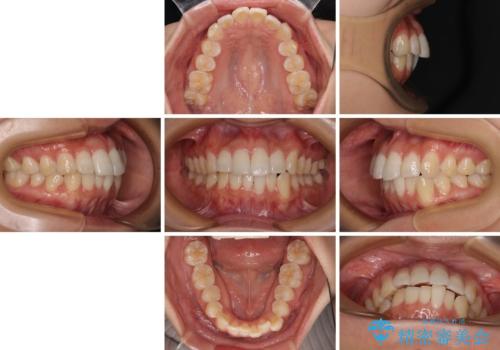 前歯のデコボコを治したい インビザライン矯正の治療前