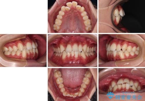 【モニター】デコボコ前歯をワイヤー装置での抜歯矯正で改善の治療前