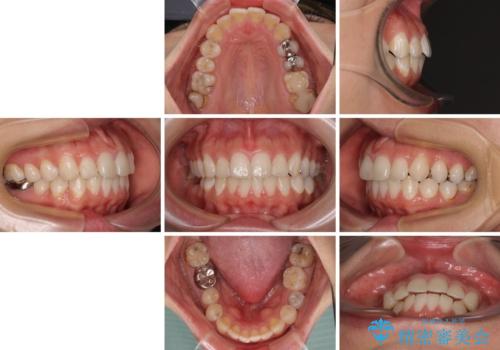 出っ歯と奥歯のむし歯 ワイヤー装置での抜歯矯正とセラミック治療の治療前