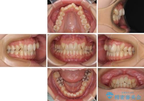 八重歯を改善 ワイヤー装置での抜歯矯正の治療前
