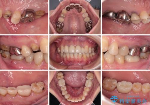 以前の治療箇所が痛む 全顎的なむし歯治療の治療前