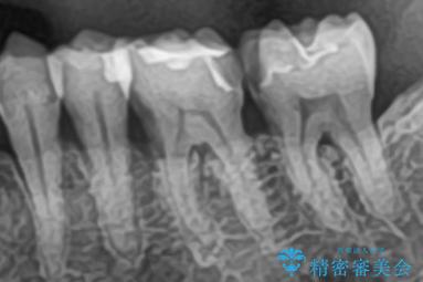 セラミックで叶える集中審美治療の治療前