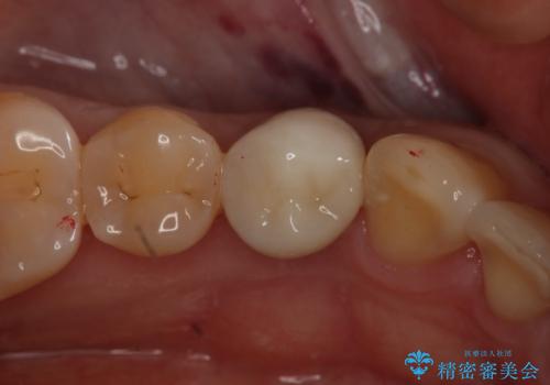 セラミックの被せ物を入れたい フルジルコニアクラウン