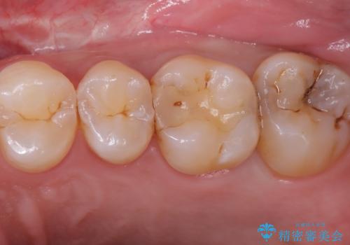 【セラミックインレー】虫歯がないか確認してほしい