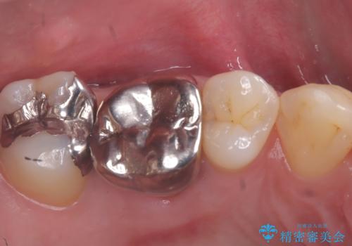 【セラミッククラウン】歯に穴が空いているの治療前