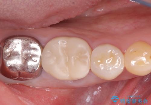 【セラミッククラウン】銀歯を白くしたいの治療前