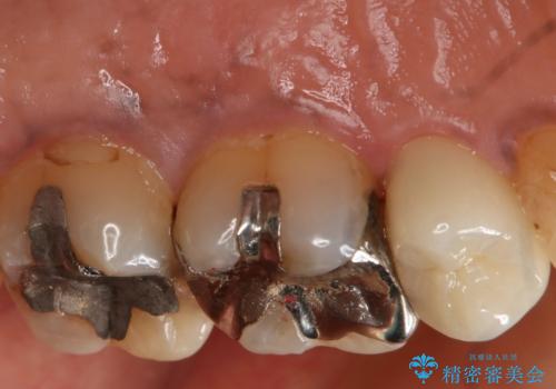 歯ぐきが腫れた フルジルコニアクラウンの治療後