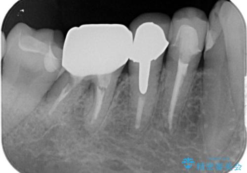 フロスがちぎれて取れない 他院の治療やり替え の治療後