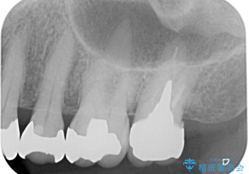 被せものに穴が開いたのでやり替えたい オールセラミッククラウンの治療後