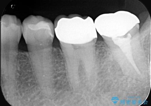 セラッミクインレー|オールセラミッククラウン|銀歯による二次カリエス|ラバーダムシート使用の治療後