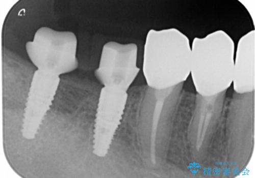 多数の銀歯と虫歯、セラミック・インプラント治療の治療中