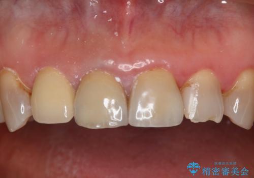 前歯を綺麗にしたい オールセラミッククラウン