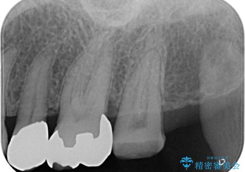 かぶせ物が外れたまま放置 伸びてしまった歯を修復の治療前