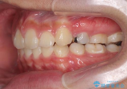 がちゃがちゃした前歯をきれいにしたいの治療後