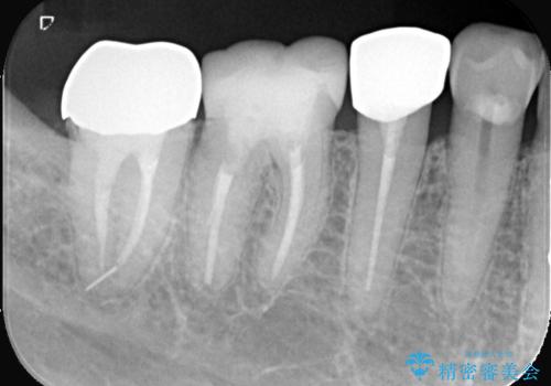 【セラミッククラウン】銀歯を白くしたいの治療前