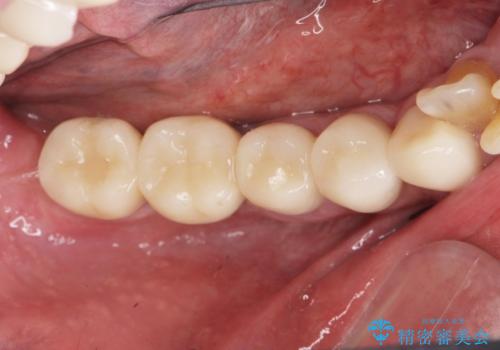 多数の銀歯と虫歯、セラミック・インプラント治療の治療後