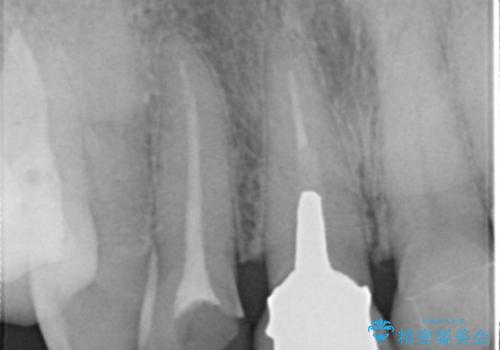 前歯を綺麗にしたい オールセラミッククラウンの治療前