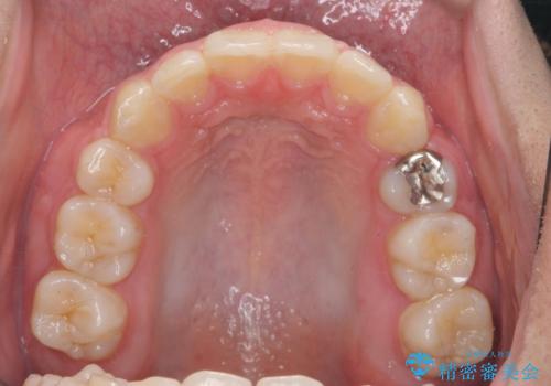 がちゃがちゃした前歯をきれいにしたいの治療後