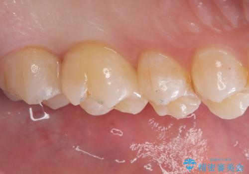 【セラミックインレー】虫歯がないか確認してほしいの治療後
