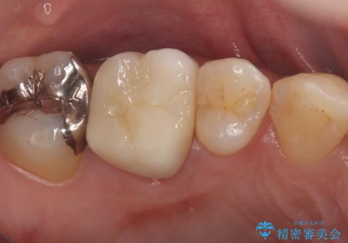 【セラミッククラウン】歯に穴が空いているの治療後