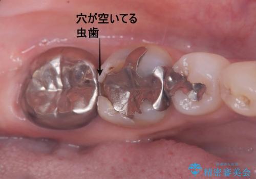 セラッミクインレー|オールセラミッククラウン|銀歯による二次カリエス|ラバーダムシート使用の治療前