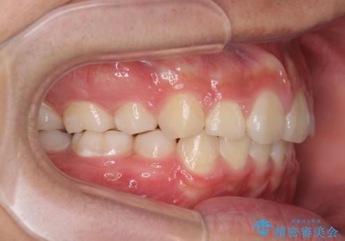 がちゃがちゃした前歯をきれいにしたい