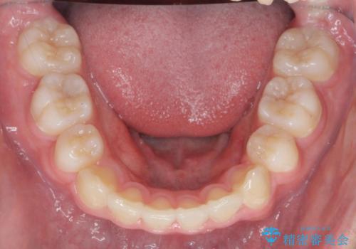 がちゃがちゃした前歯をきれいにしたいの治療後